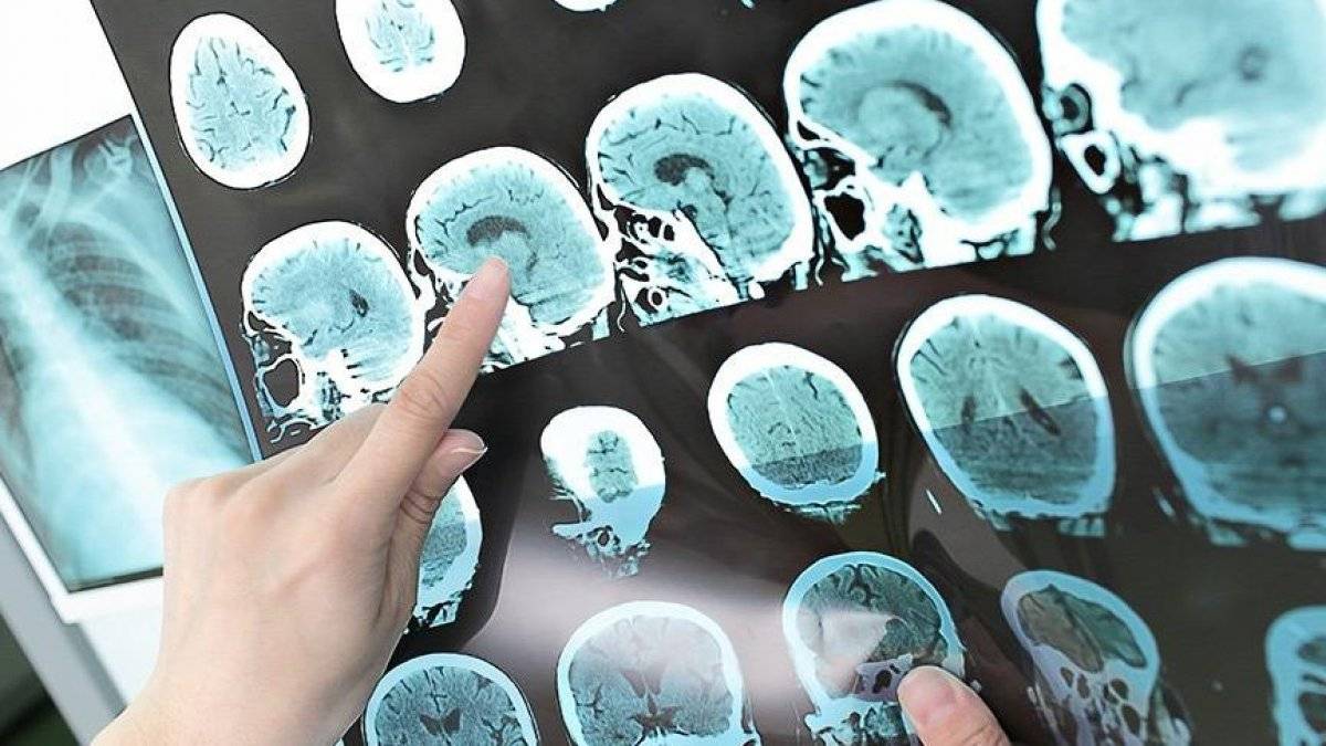 BioNTech, MS hastaları için aşı geliştiriyor