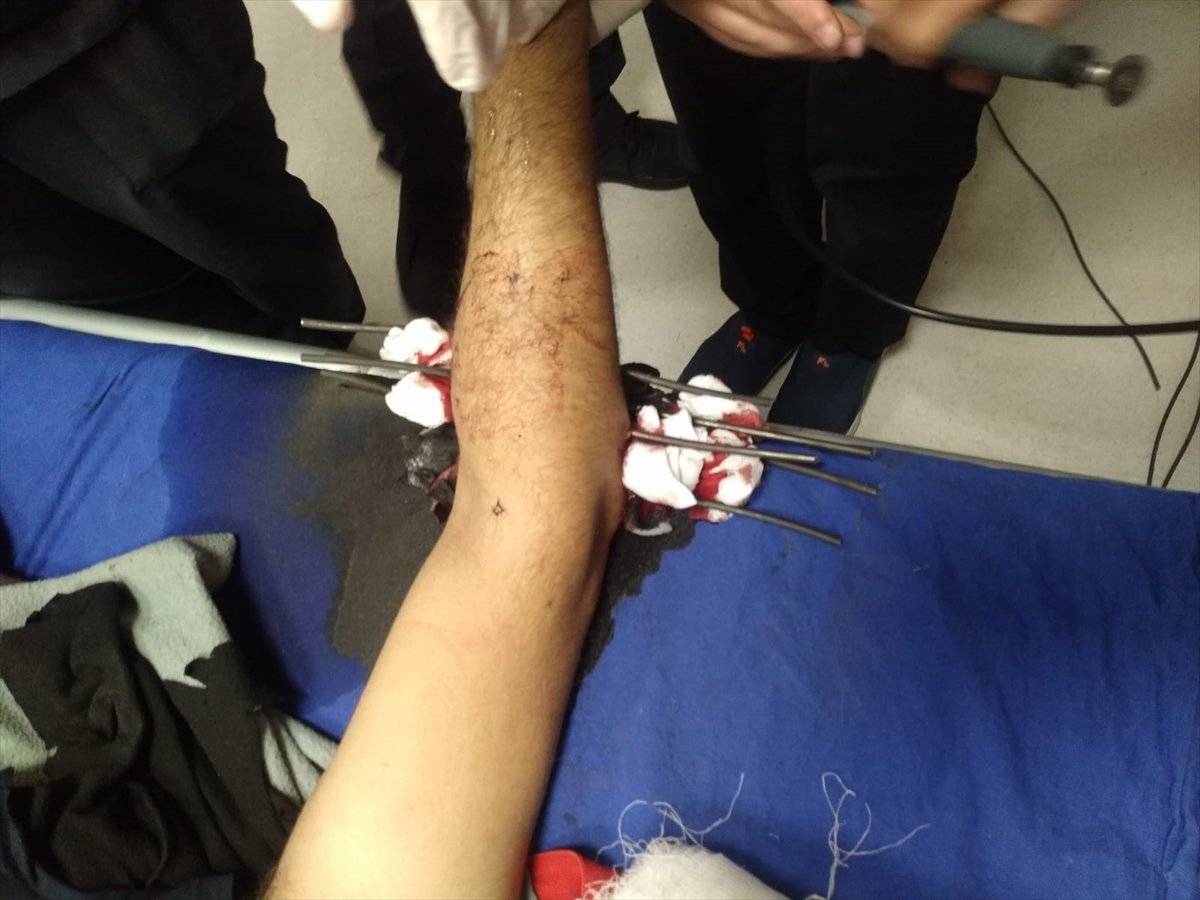 Sivas'ta YHT inşaatında koluna çelik tel saplanan işçi yaralandı