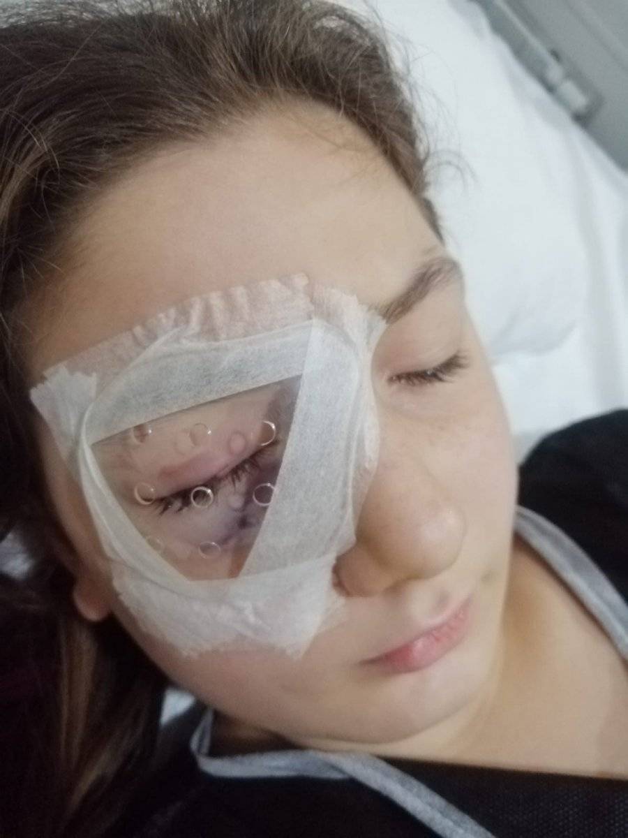 Aydın'da, yastık savaşı yaparken kırılan avize gözünü parçaladı