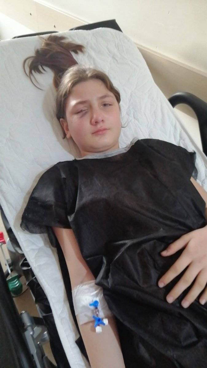 Aydın'da, yastık savaşı yaparken kırılan avize gözünü parçaladı