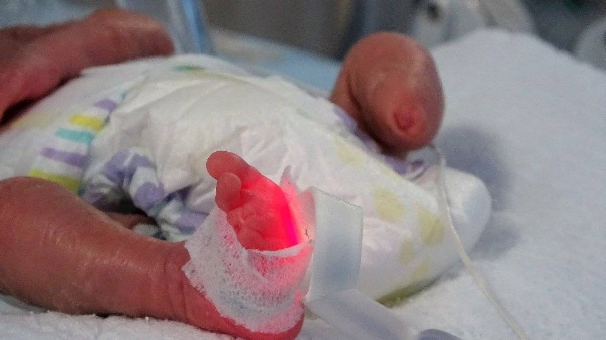 Tokat'ta tek ayaklı doğan prematüre bebek, yaşama tutundu