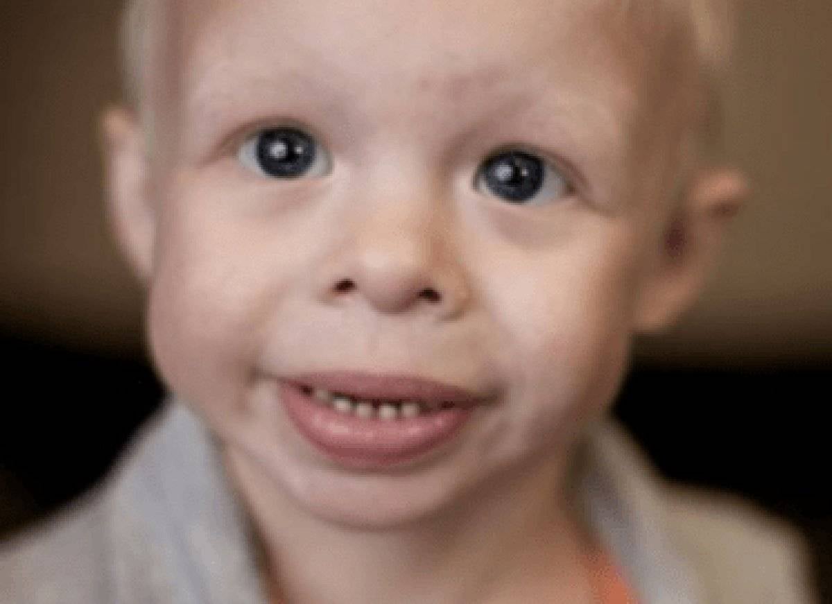 Angelman sendromu nedir