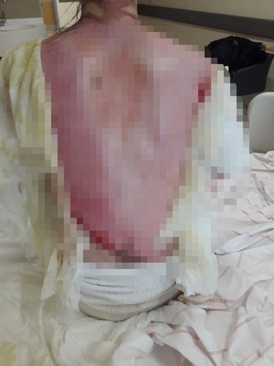 Konya'da eşini kaynar suyla yakan koca: Kazara oldu