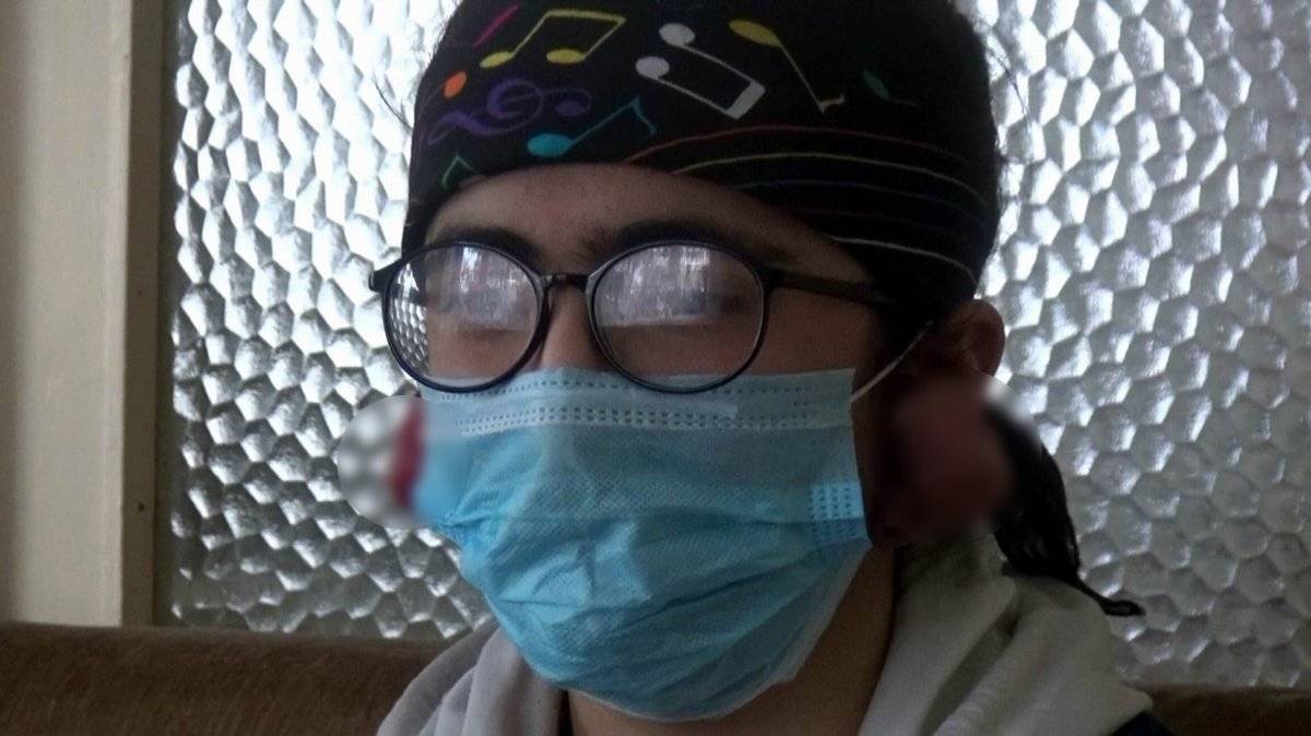 Erzincan'da kulaklarında keloid oluşan Yağmur yardım bekliyor
