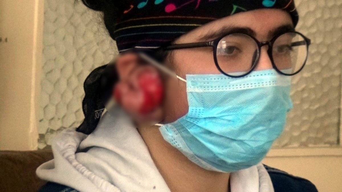 Erzincan'da kulaklarında keloid oluşan Yağmur yardım bekliyor