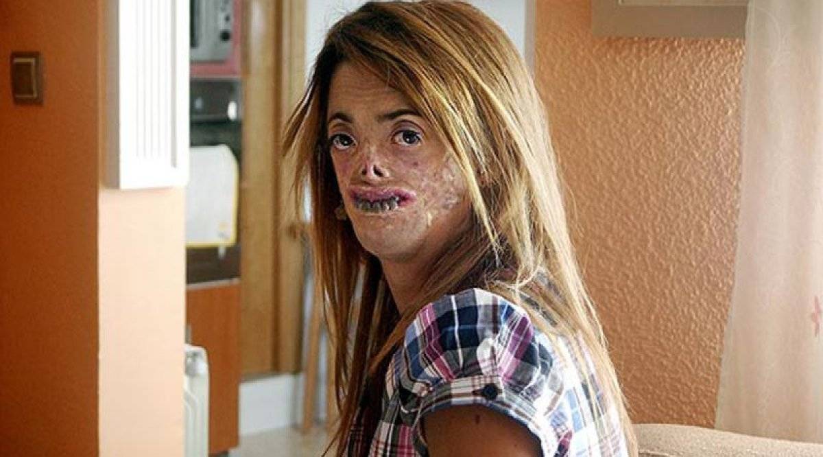 Porfiria hastalığı nedir? Vampir hastalığı Porfiria belirtileri nelerdir? Türkiye'de görüldü mü?