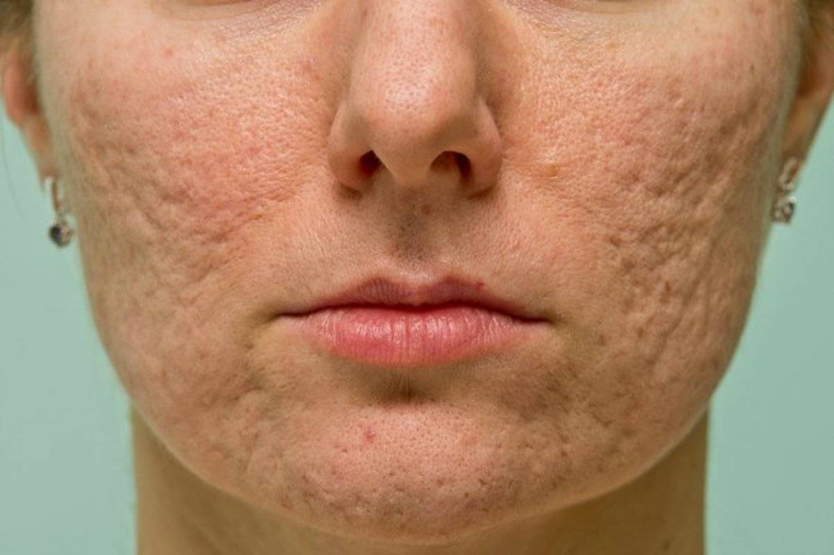Roaccutane nedir? Sivilceler için Roaccutane nasıl kullanılır? Roaccutane yan etkileri nelerdir?