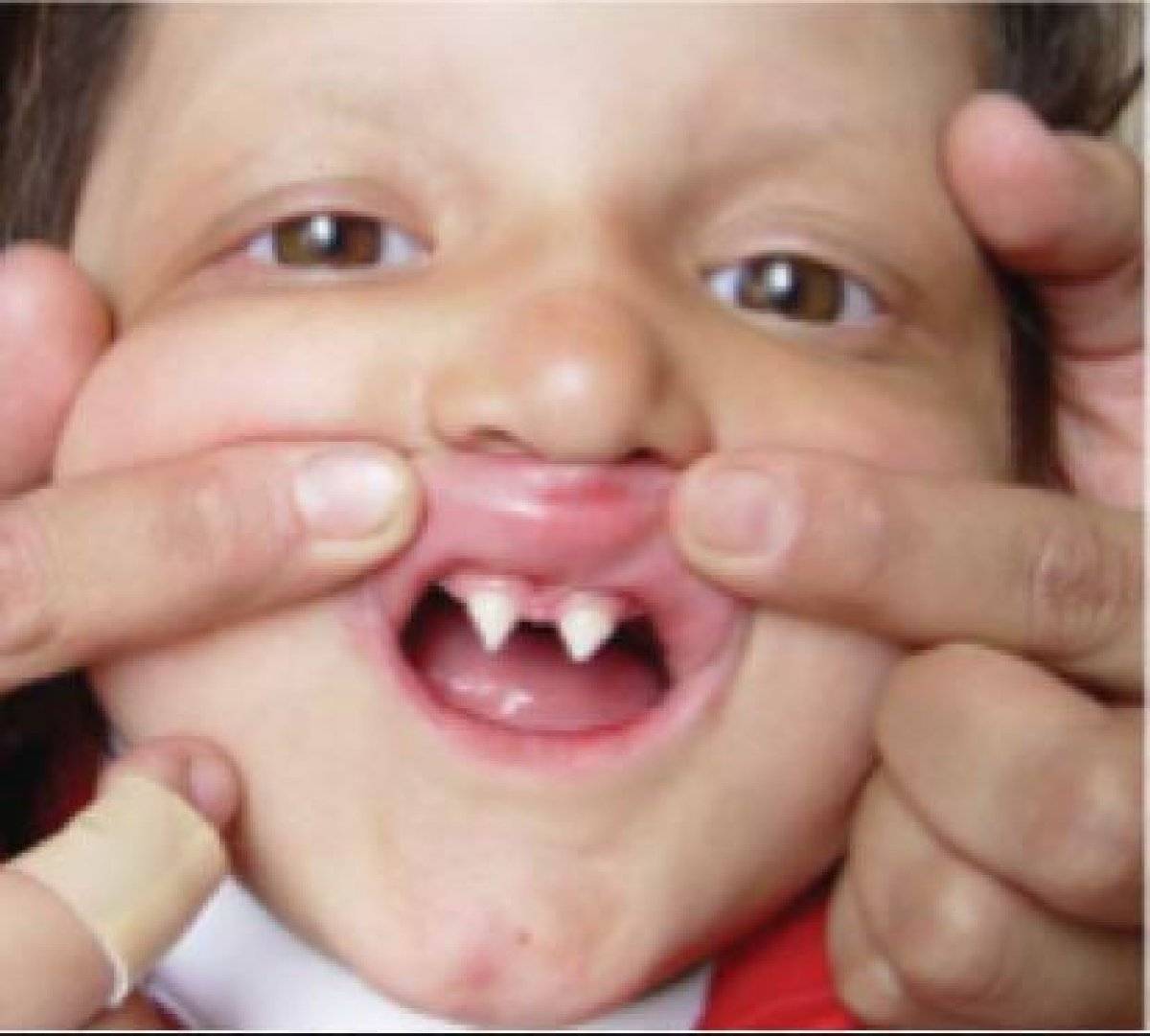 Porfiria hastalığı nedir? Vampir hastalığı Porfiria belirtileri nelerdir? Türkiye'de görüldü mü?