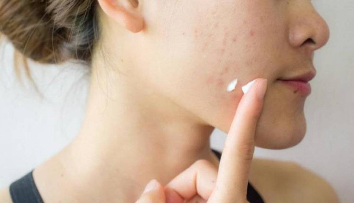 Roaccutane nedir? Sivilceler için Roaccutane nasıl kullanılır? Roaccutane yan etkileri nelerdir?