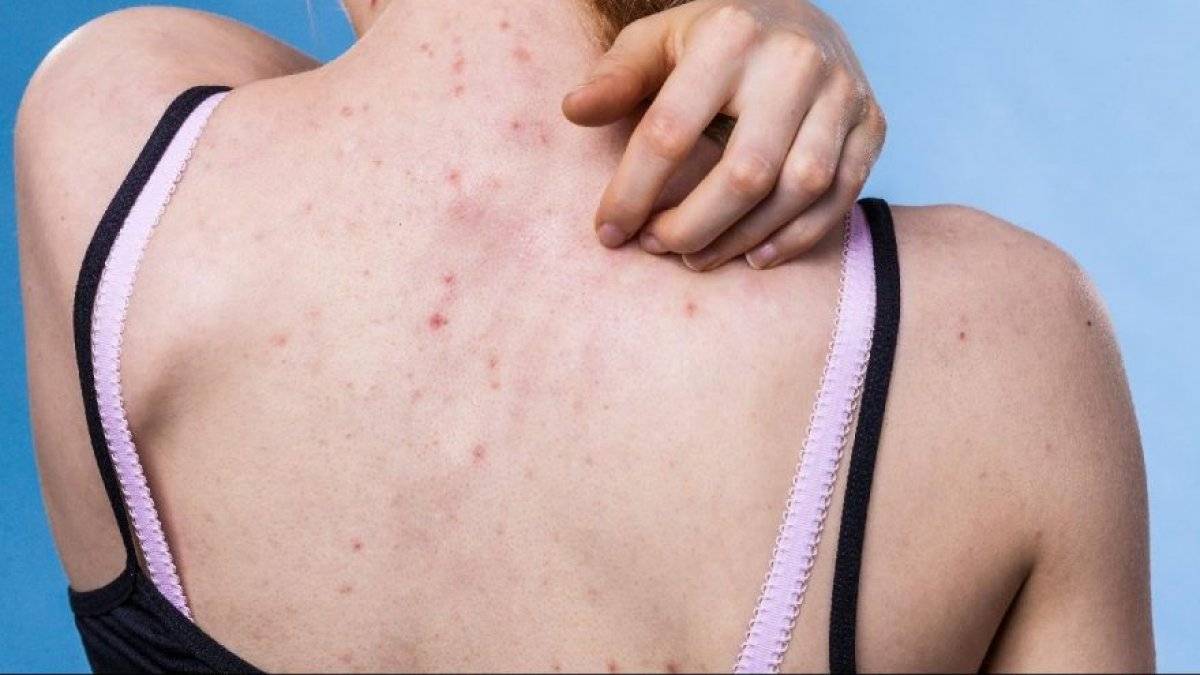 Roaccutane nedir? Sivilceler için Roaccutane nasıl kullanılır? Roaccutane yan etkileri nelerdir?