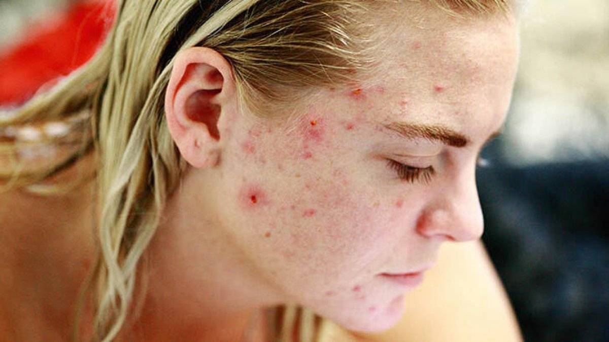 Roaccutane nedir? Sivilceler için Roaccutane nasıl kullanılır? Roaccutane yan etkileri nelerdir?