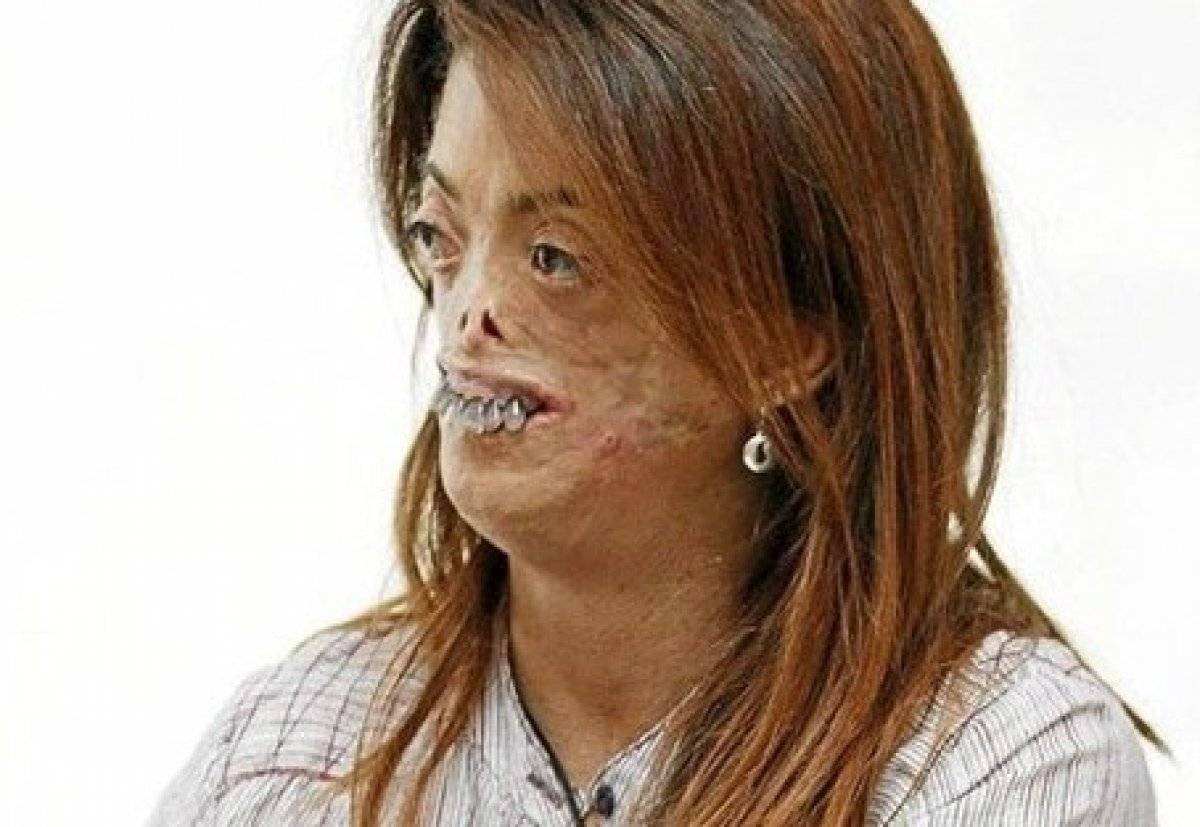 Porfiria hastalığı nedir? Vampir hastalığı Porfiria belirtileri nelerdir? Türkiye'de görüldü mü?