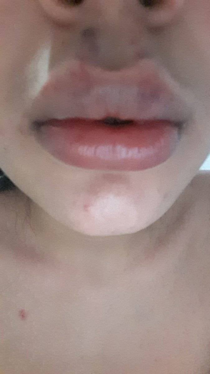 Eskişehir'de dolgu yaptıran kadın, dudaklarını kaybediyordu