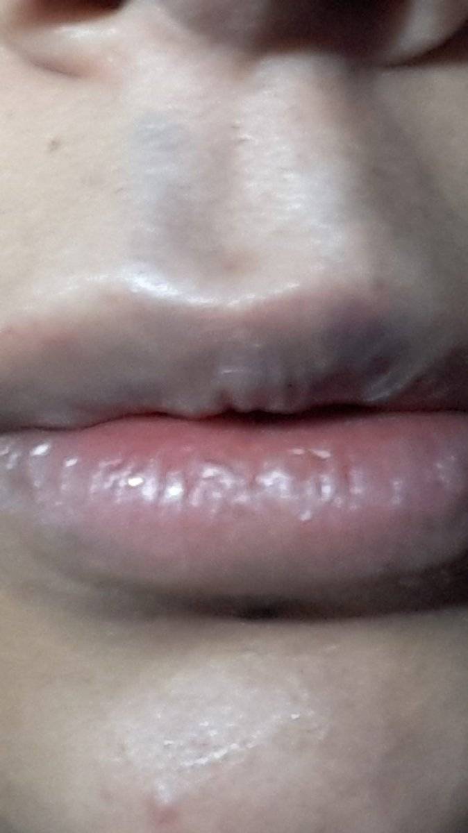 Eskişehir'de dolgu yaptıran kadın, dudaklarını kaybediyordu