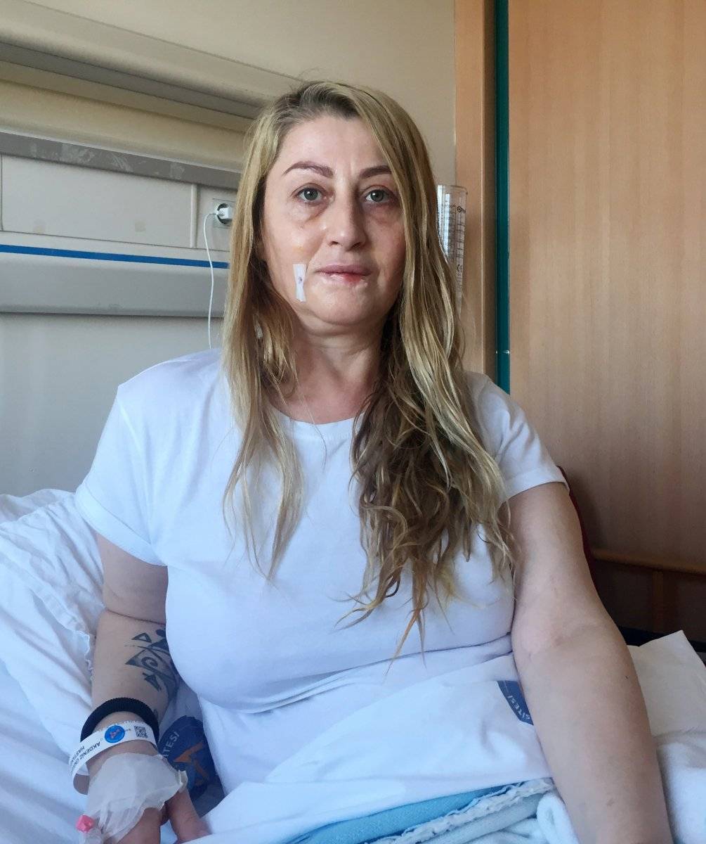 Antalya'da estetik sonrası kaybettiği dudağına yeniden kavuşuyor