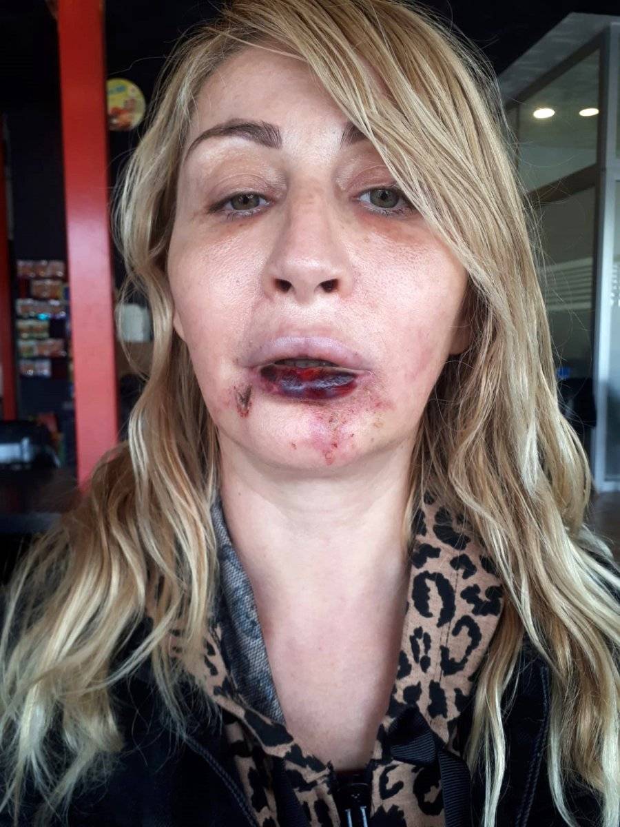 Antalya'da estetik sonrası kaybettiği dudağına yeniden kavuşuyor