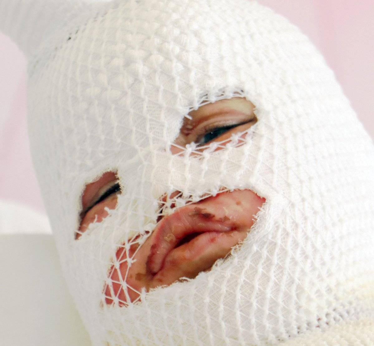 Kars'ta 2 yaşındaki çocuğun üzerine çaydanlık devrildi