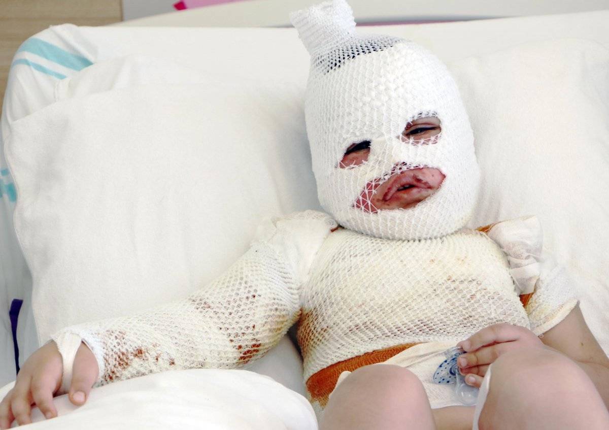 Kars'ta 2 yaşındaki çocuğun üzerine çaydanlık devrildi