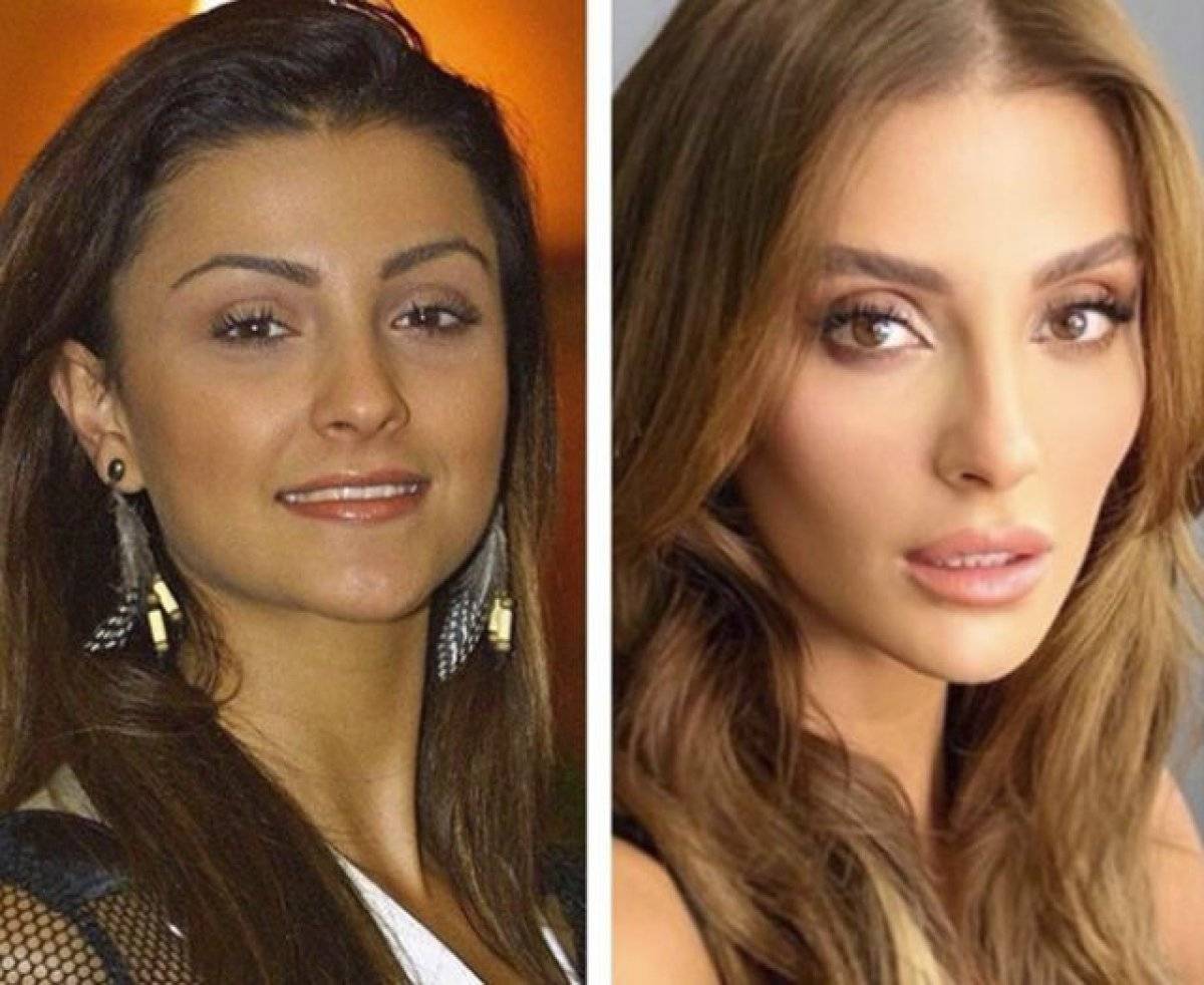 Özge Ulusoy bu kez estetiği kabul etti