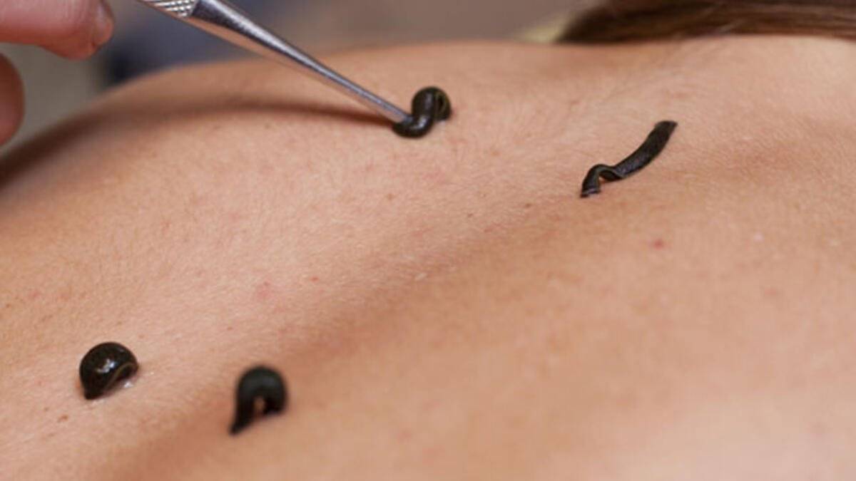 Sülük tedavisi nedir, nasıl yapılır? Sülük tedavisi faydaları nelerdir? Sülük tedavisi hakkında bilgiler..