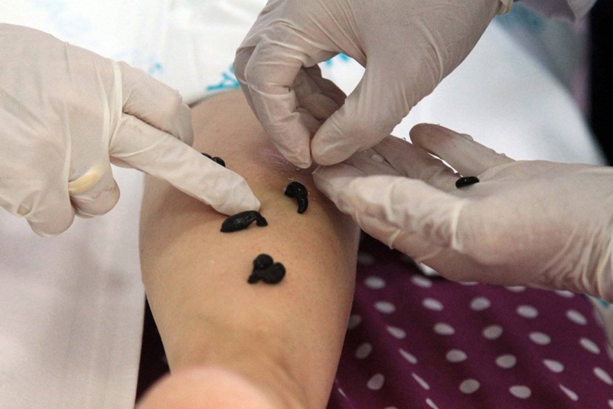 Sülük tedavisi nedir, nasıl yapılır? Sülük tedavisi faydaları nelerdir? Sülük tedavisi hakkında bilgiler..