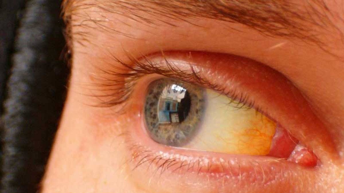 Hijyene dikkat ederek sarılık hastalığından korunmak mümkün