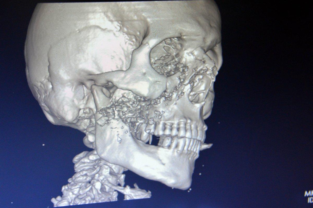Kahramanmaraş'ta spiral makinesiyle demir keserken yüzü parçalandı