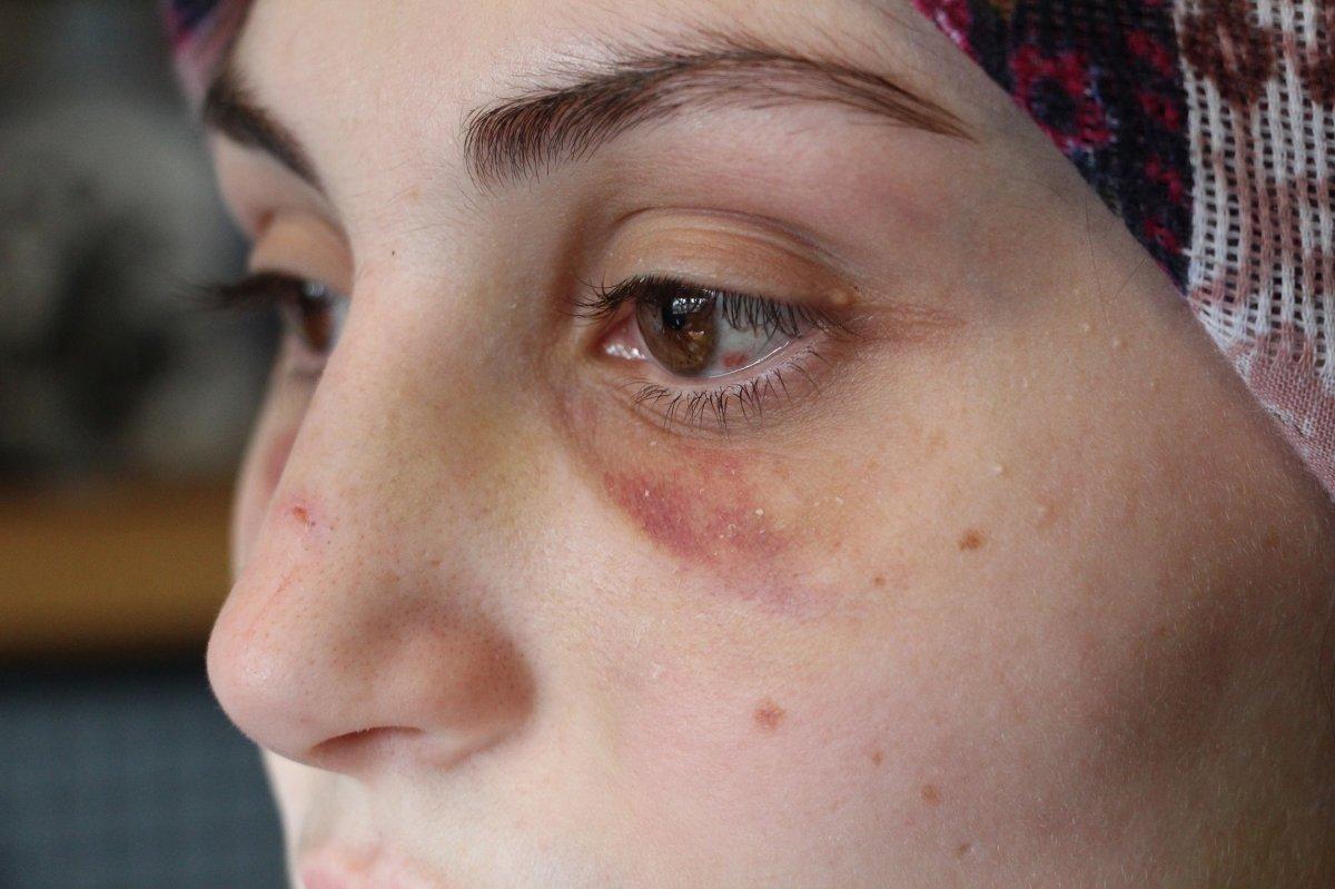 Antalya'da eşinden şiddet gören kadın