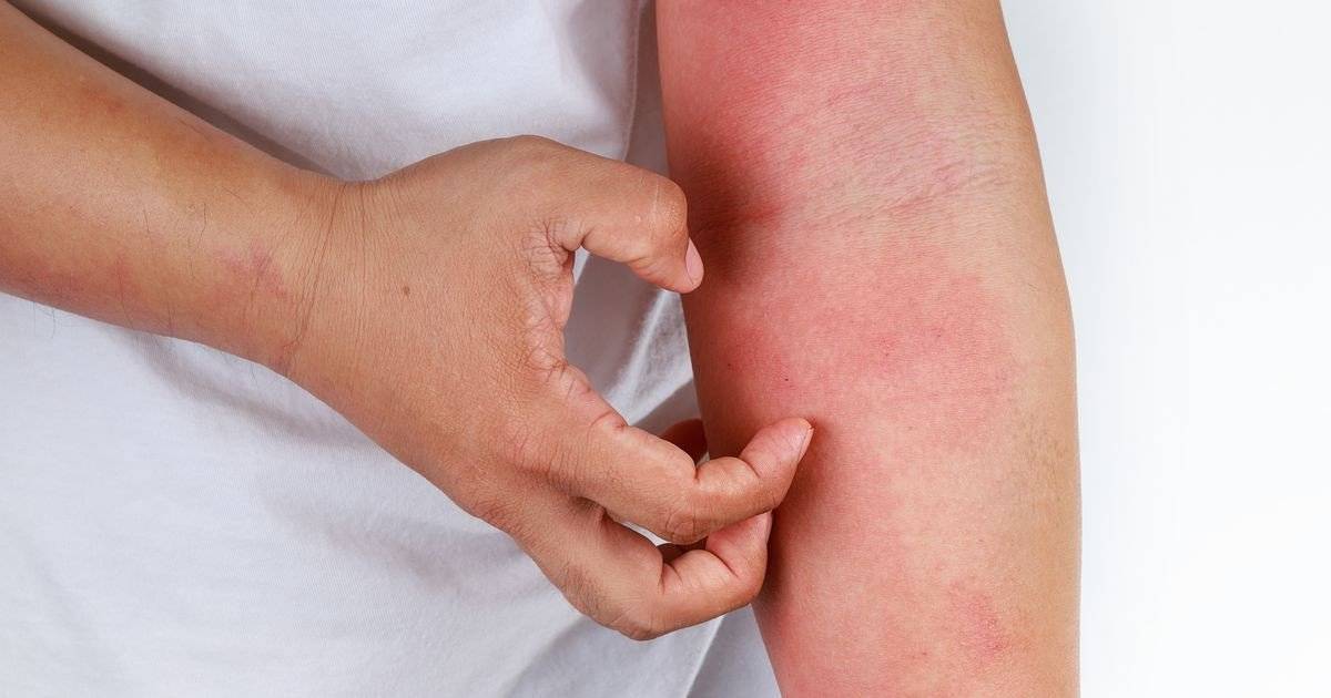 Uyuz belirtileri ve tedavi yöntemleri