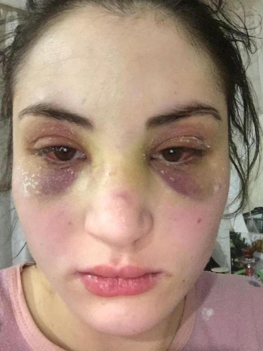 Antalya'da eşinden şiddet gören kadın