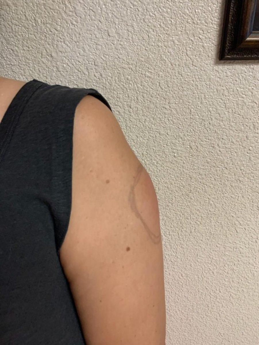 Covid-19 kolu nedir, belirtileri nelerdir? Hangi aşı Covid-19 koluna neden olur?