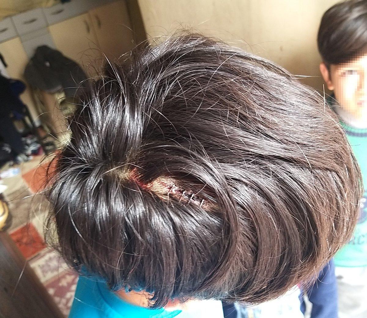 Samsun'da ağabeyini sopayla kafasından yaraladı