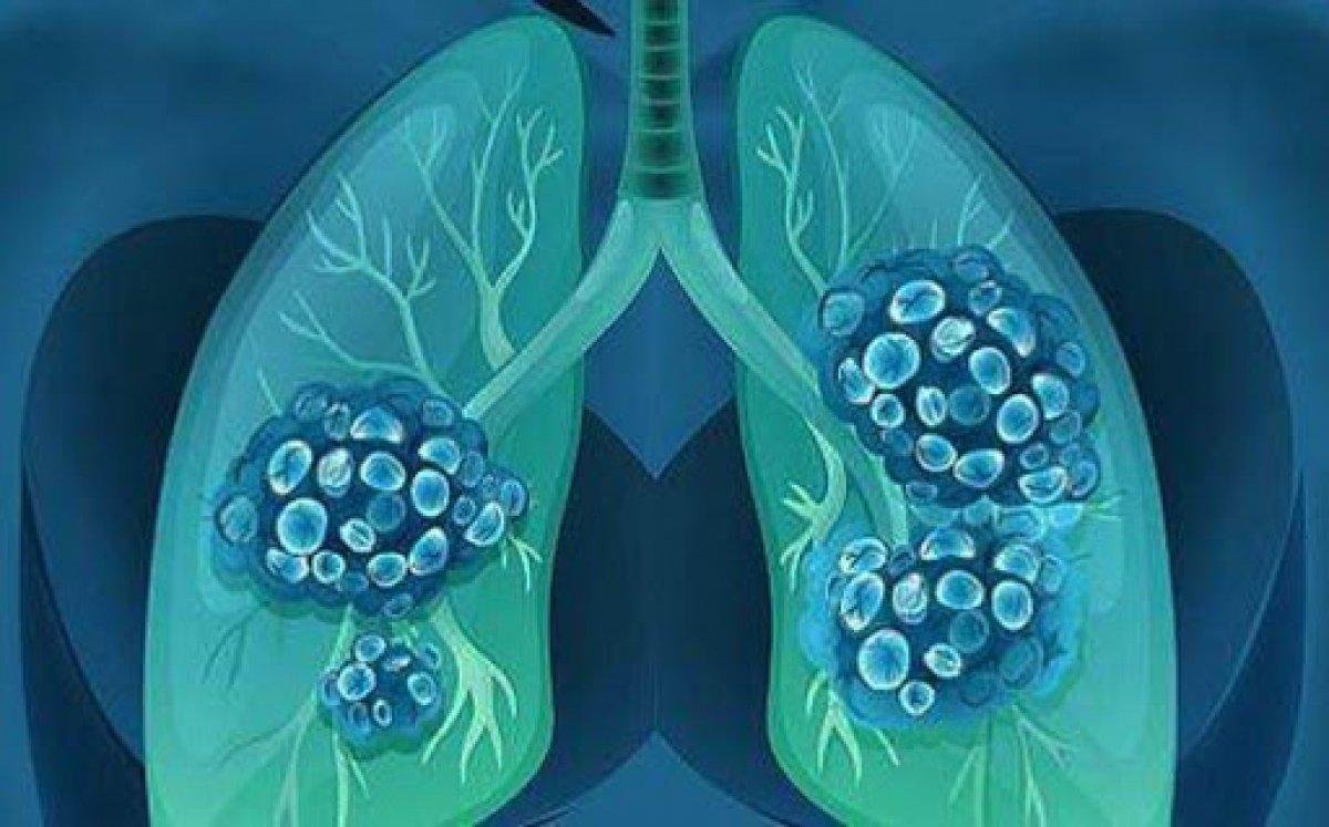 Bronşiolit nedir, belirtileri nelerdir? Brionşiolit neden olur, bronşitten farkı nedir?