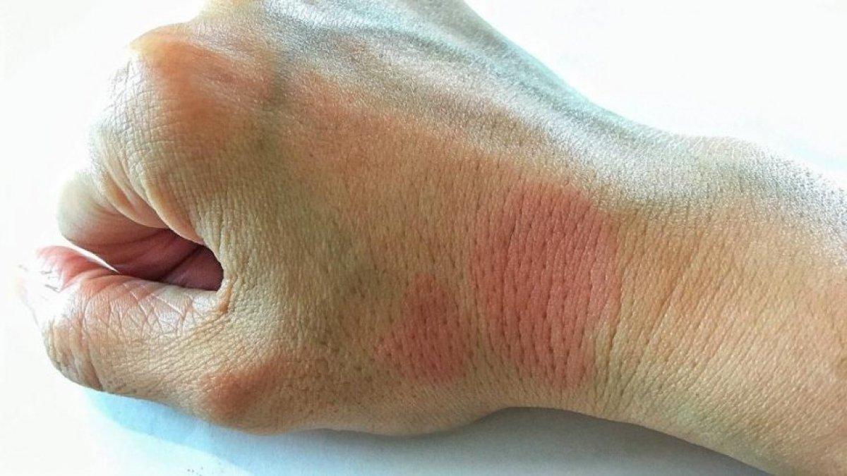 Lupus (kelebek hastalığı) nedir, belirtileri nelerdir? Lupus hastalığı tedavisi var mı?