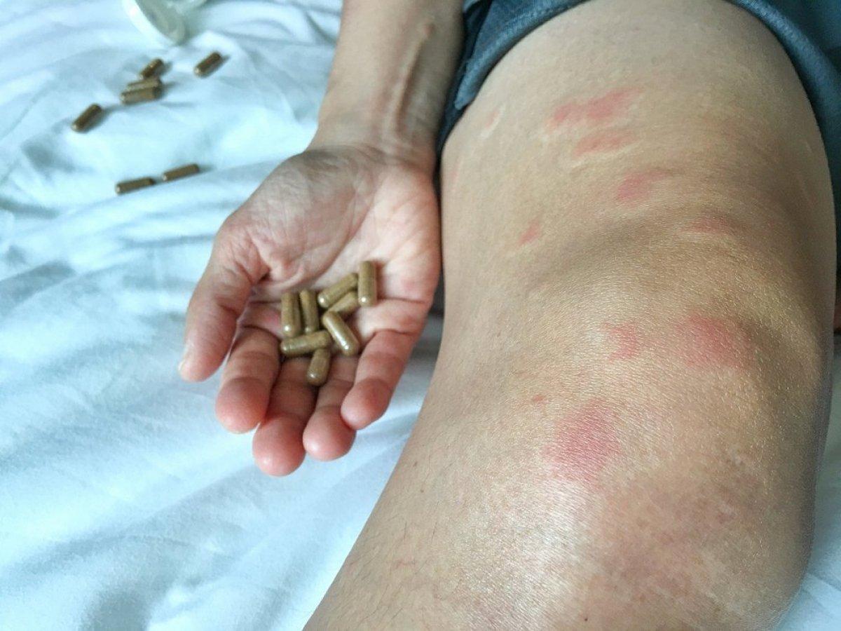 Lupus (kelebek hastalığı) nedir, belirtileri nelerdir? Lupus hastalığı tedavisi var mı?