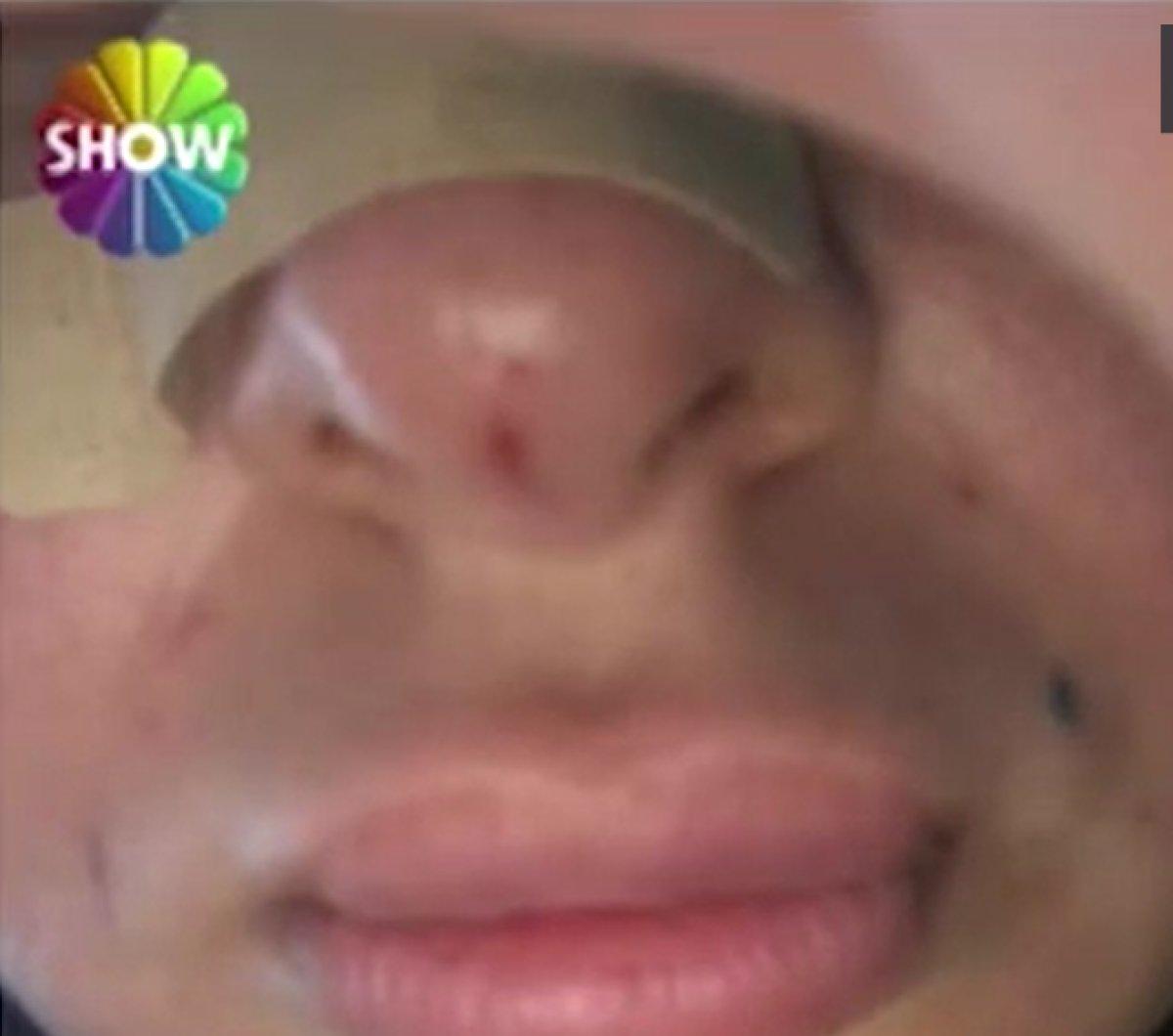 İstanbul'da botoks yaptırdığı estetisyen şarkıcı çıktı