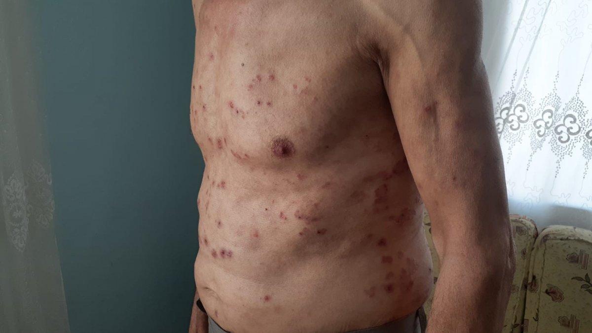 Osmaniye’de 13 yıldır kaşıntısına çare arıyor