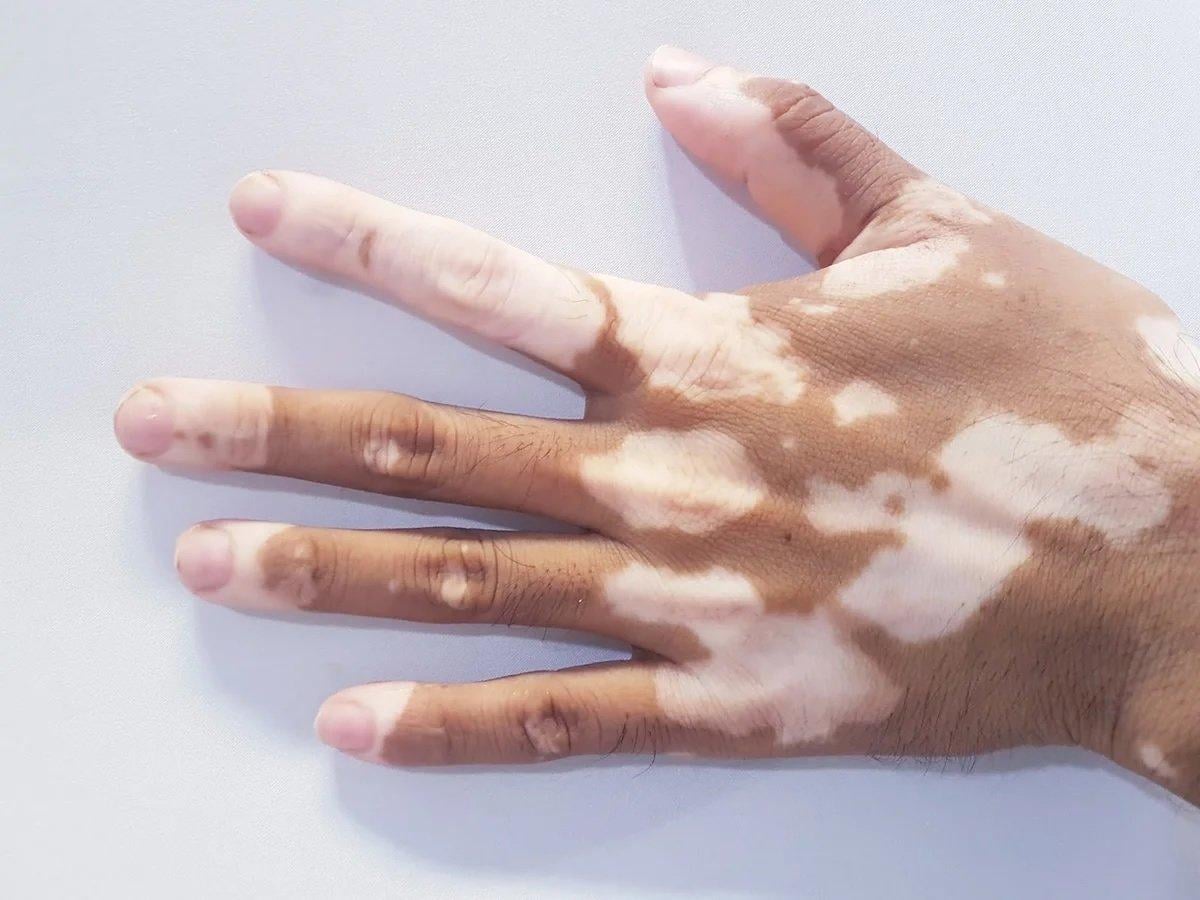 Ciltte renk değişikliğinin nedenleri ve tedavi yöntemleri