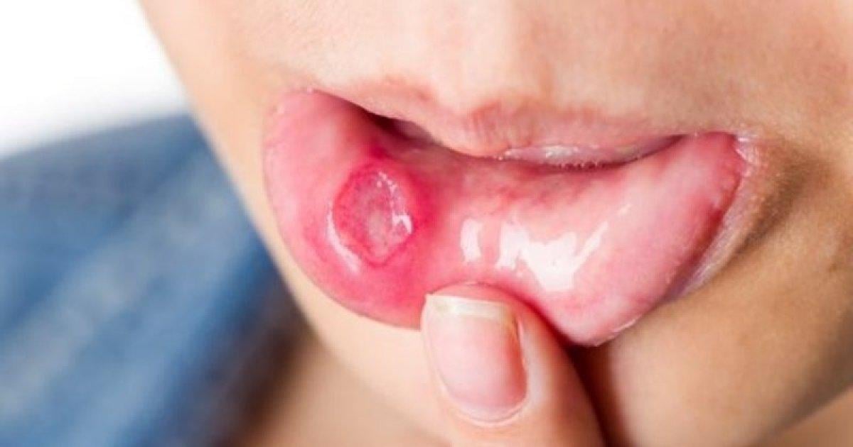 Ağız mantarı nedir, belirtileri nelerdir? Maske nedeniyle oluşan ağız mantarı nasıl önlenir?