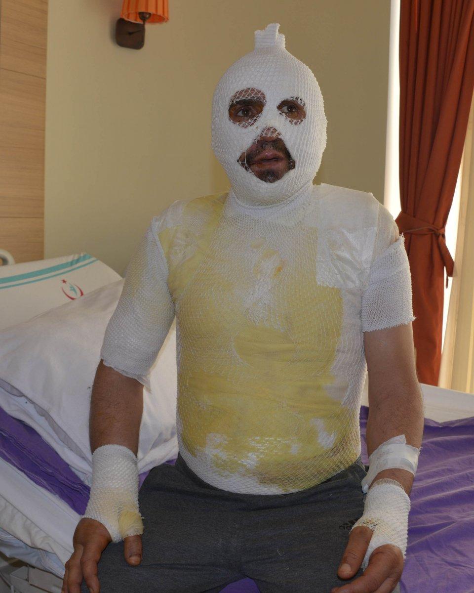 Iğdır'da taciz iddiası sonrası sobadan devrilen su ile yandı