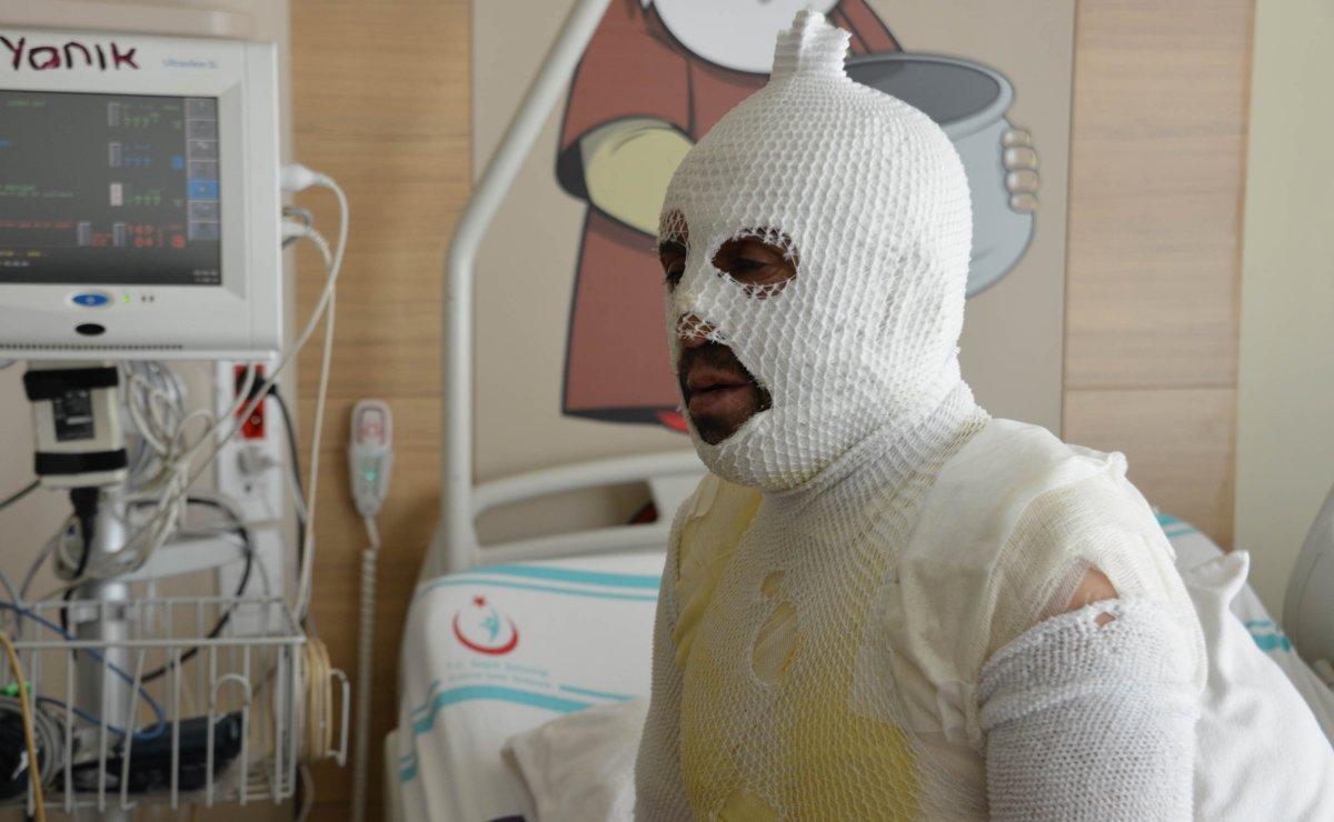 Iğdır'da taciz iddiası sonrası sobadan devrilen su ile yandı