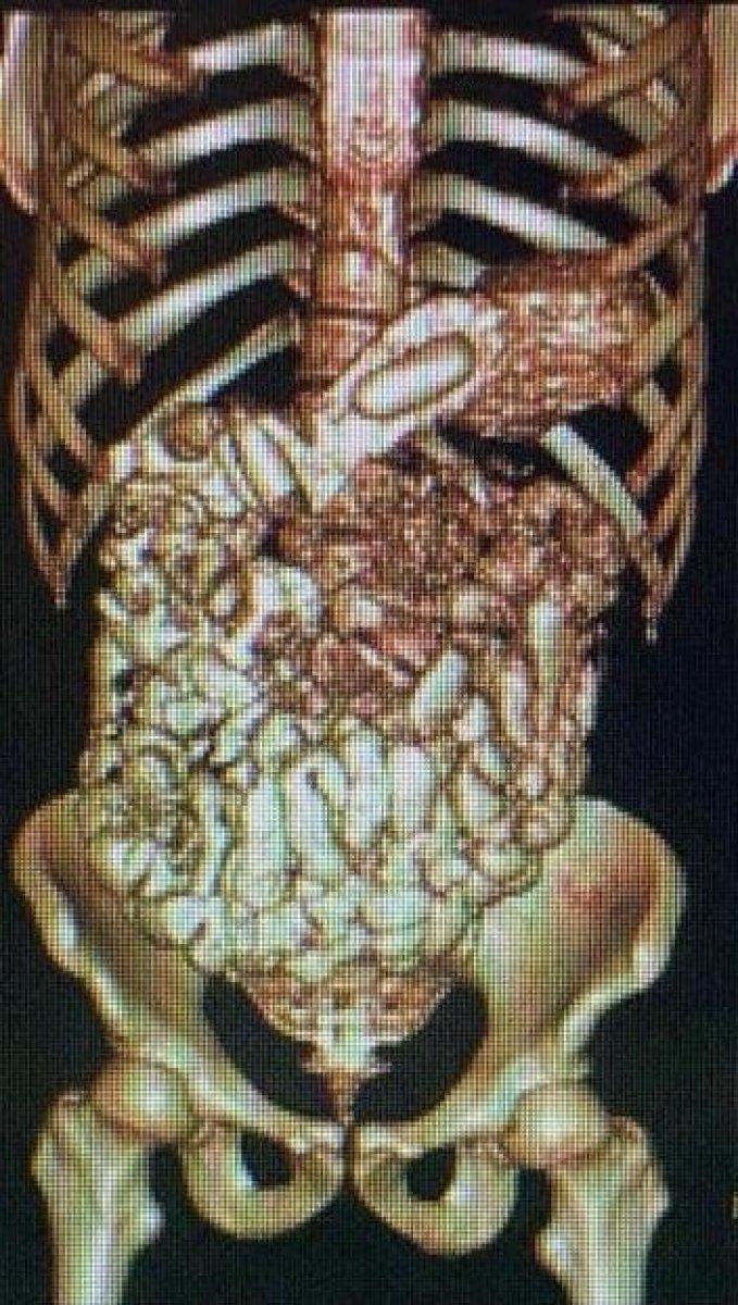 Muş'ta midelerinde uyuşturucu gizleyen 2 kişi yakalandı