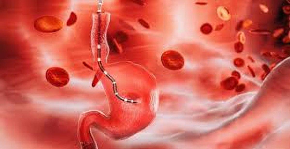 Aort damarı yırtılması nedir, neden olur, belirtileri nelerdir? Aort damarı yırtılması tedavisi var mı?