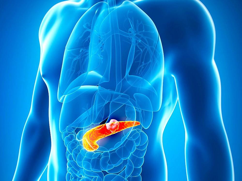 Pankreas kanserini mide ağrısıyla karıştırmayın