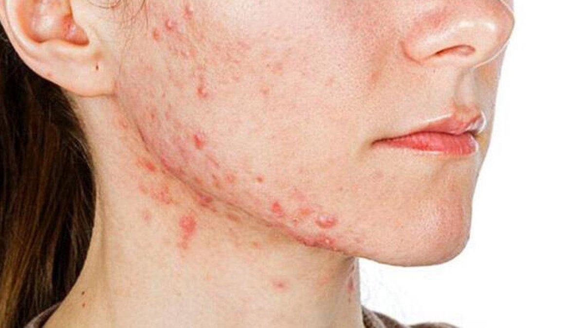 Maske aknesi (Maskne) nedir, neden olur? Maskne nasıl önlenir?