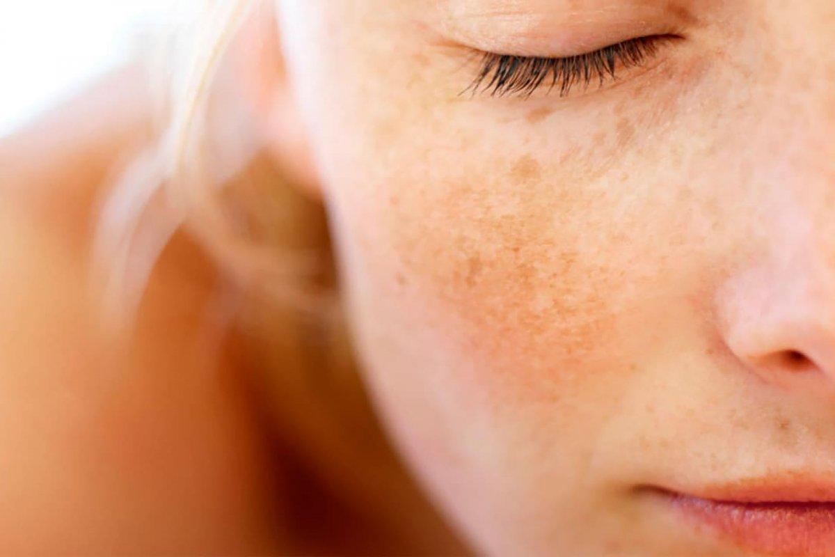 Sigaranın cilde verdiği 6 zarar