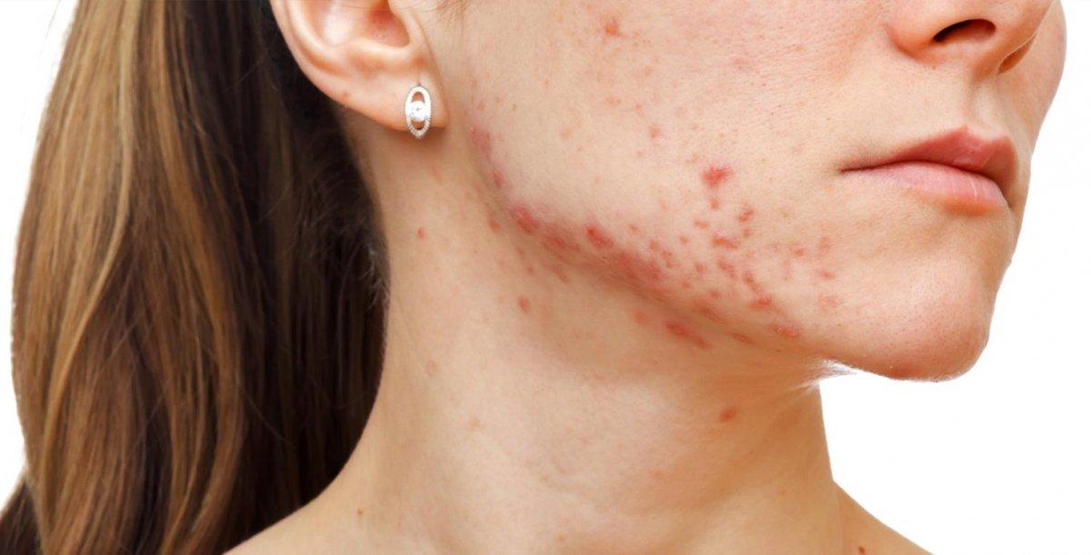 Sigaranın cilde verdiği 6 zarar