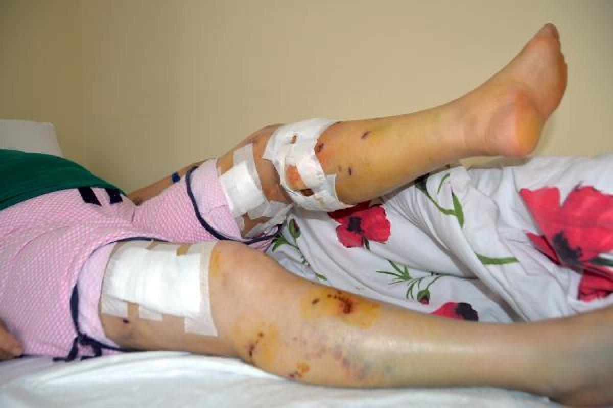 Mersin'de sokak köpeklerinin saldırısına uğrayan kadın