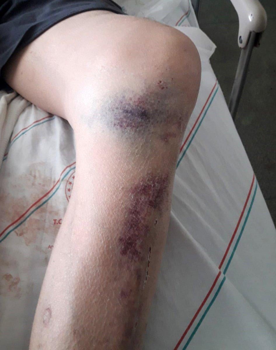 Antalya'da darbedilen yüzde 90 engelli yaşamını yitirdi