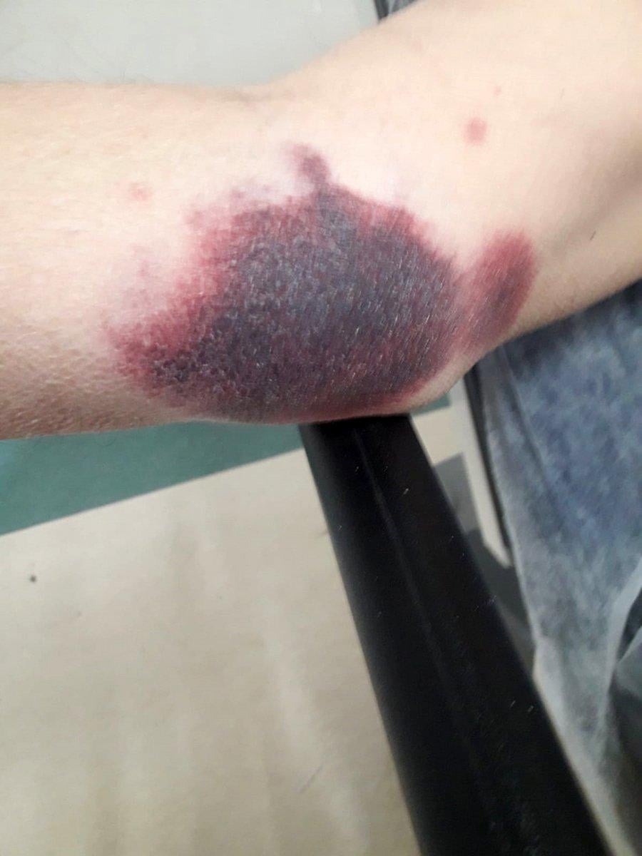 Antalya'da darbedilen yüzde 90 engelli yaşamını yitirdi